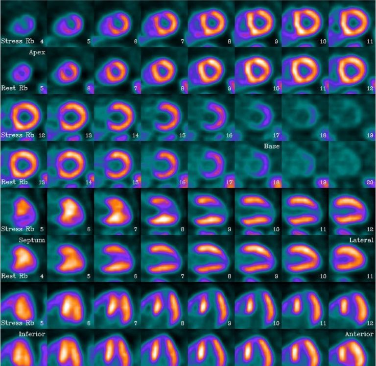 Case Study 2 | Mobile PET Imaging | Cardiac Imaging