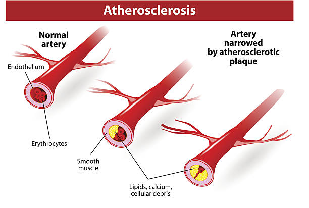 PET/CT for Detailed Atherosclerosis Images & Diagnostics